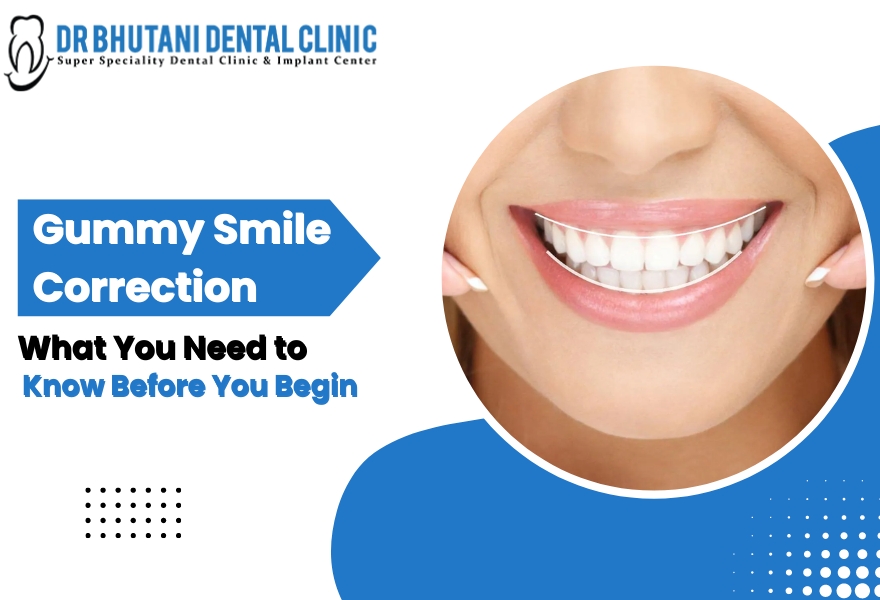 Gummy Smile Correction