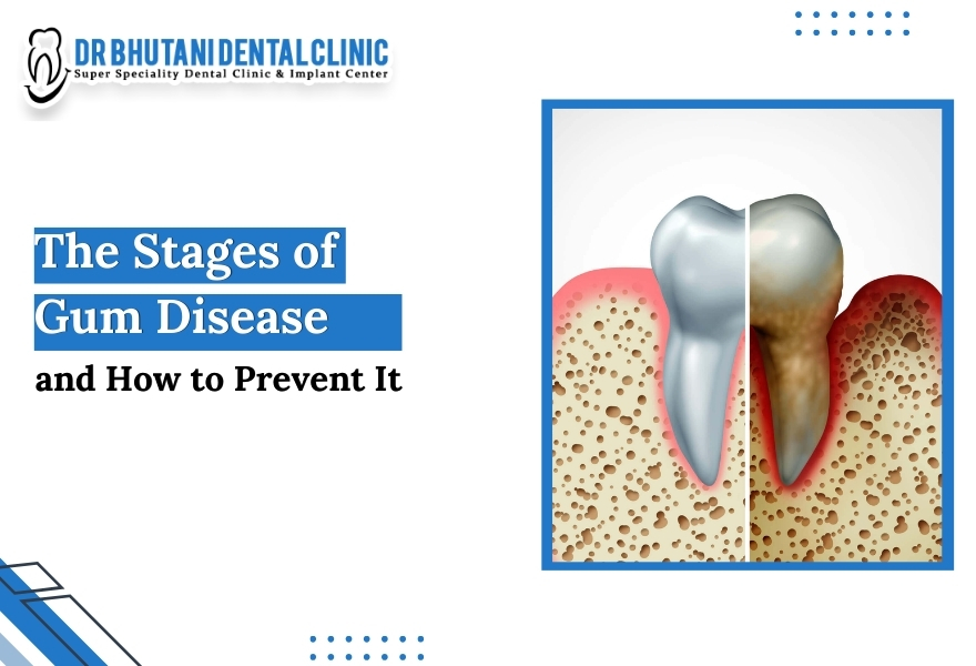 Gum diseases