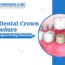 Dental Crown Procedure