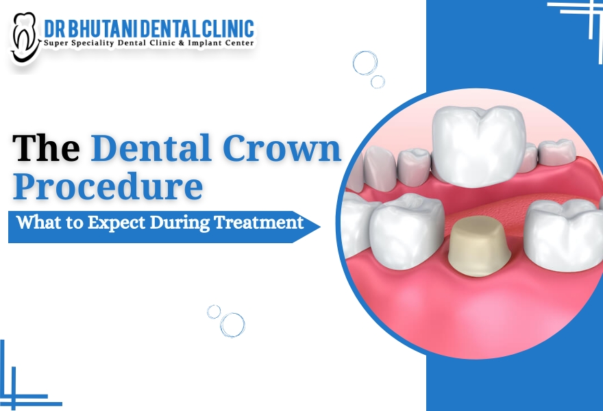 Dental Crown Procedure