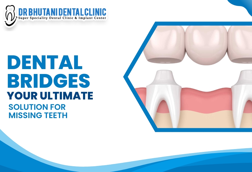 Dental Bridges