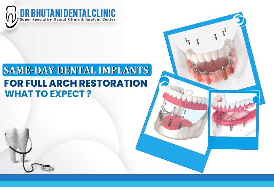 Same Day Dental Implants