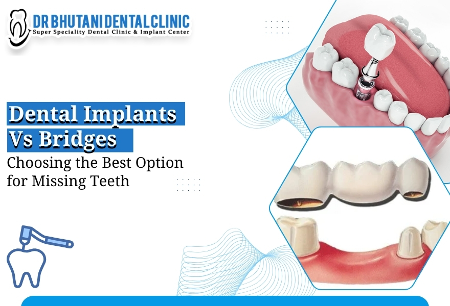 Dental Implants In Delhi