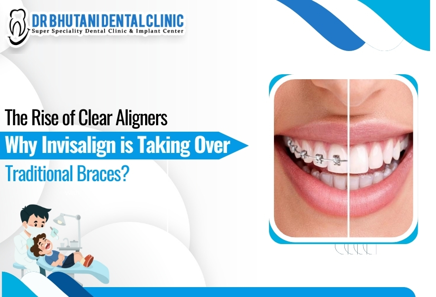 Clear Aligners Cost In India