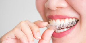 Invisible Teeth Braces In Delhi, India | Invisible Teeth Aligners Cost